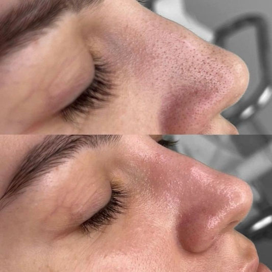 The Science behind SALICYLIC ACID: How it Transforms Acne-Prone Skin
